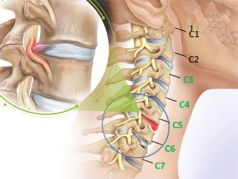 Thoái hóa đốt sống cổ - nguyên nhân - cách điều trị